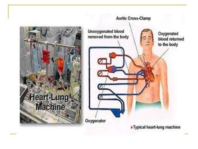 The requirement of extracorporeal circulation system for transluminal aortic valve replacement: Do we really need it in the catheterization laboratory?