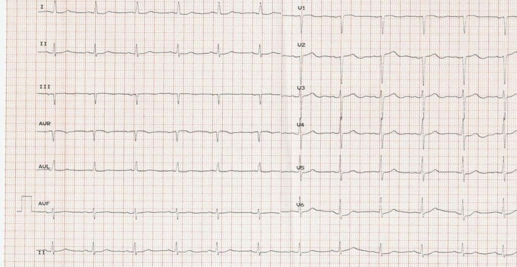 Pacemaker Implantation