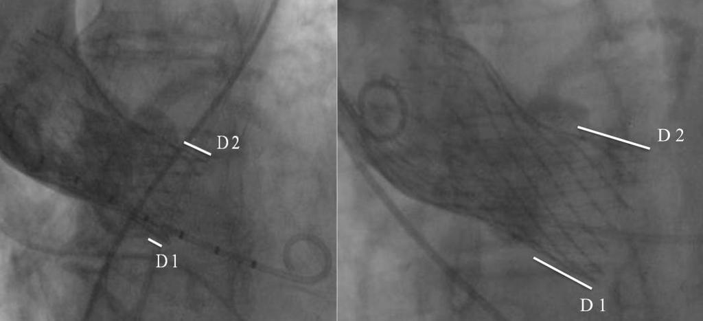 IMPLANTATION (0-8mm)