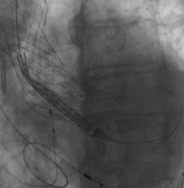 CoreValve Valve -through