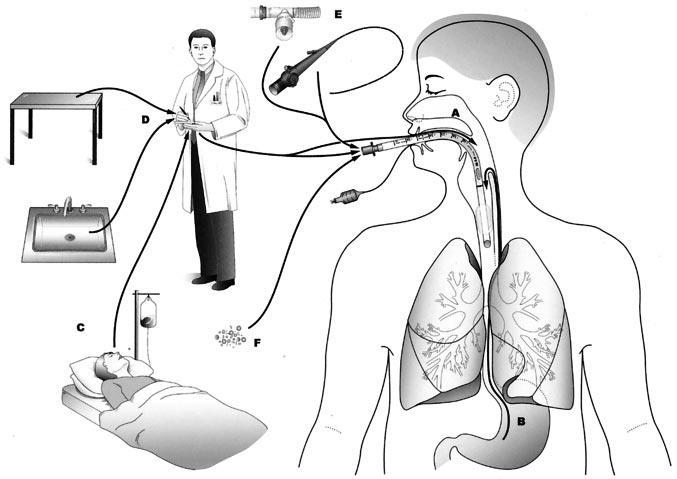 μηχανισμός της μόλυνσης σε ασθενείς υπό μηχανικό αερισμό, είναι οι μικροοισροφήσεις στοματοφαρυγγικού περιεχομένου εντός των απομεμακρυσμένων βρόγχων ακολουθούμενη από πολλαπλασιασμό των βακτηρίων