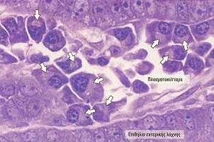 Πλασματοκύτταρα Μεγάλα ωοειδή κύτταρα με βασίφιλο