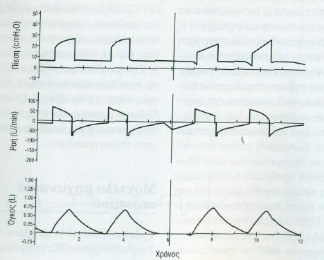 Σχήμα 3.2. Κυματομορφές αναπνευστήρα σε μηχανικό αερισμό Assisted Control Ventilation (ACV) (προσαρμοσμένο από (Μυριανθεύς & Μπαλτόπουλος,2005).