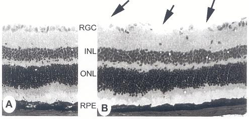 Εικόνα 14. Α-Φυσιολογικός αμφιβληστροειδής, Β- Αμφιβληστροειδής μετά από in vivo έκθεση σε αυξημένες συγκεντρώσεις Hcy, όπου και διακρίνεται (βέλη) η απώλεια των γαγγλιακών κυττάρων.