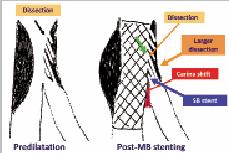 π (π π stent): Percutaneous coronary