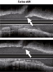 π stent πω Μ Percutaneous coronary intervention for bifurcation lesions: 2008 consensus