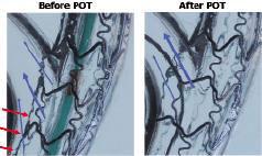 φ stent («provisional side branch stenting»), POT Percutaneous coronary intervention for bifurcation