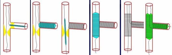 φ stent SB: TAP,