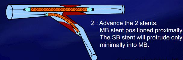 φ stent