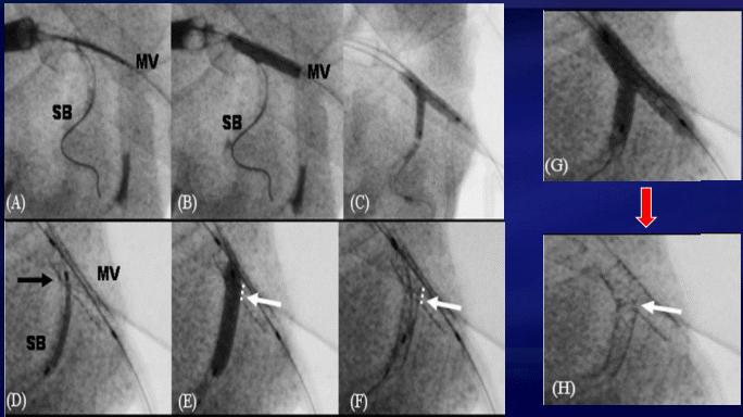 φ stent/sb: TAP, Burzotta et al.