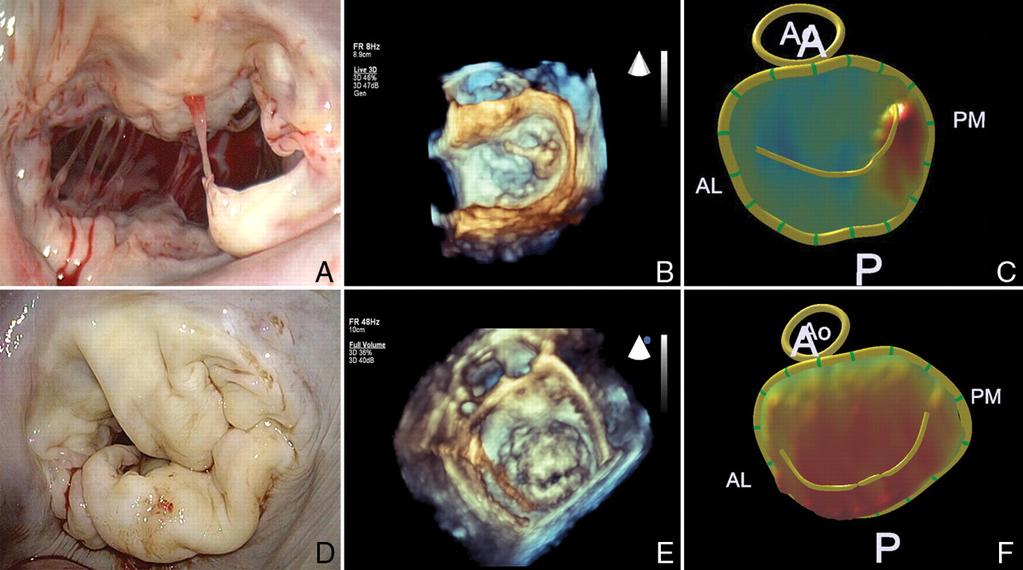 Echocardiographic differentiation of degenerative mitral disease Adams D H et al.