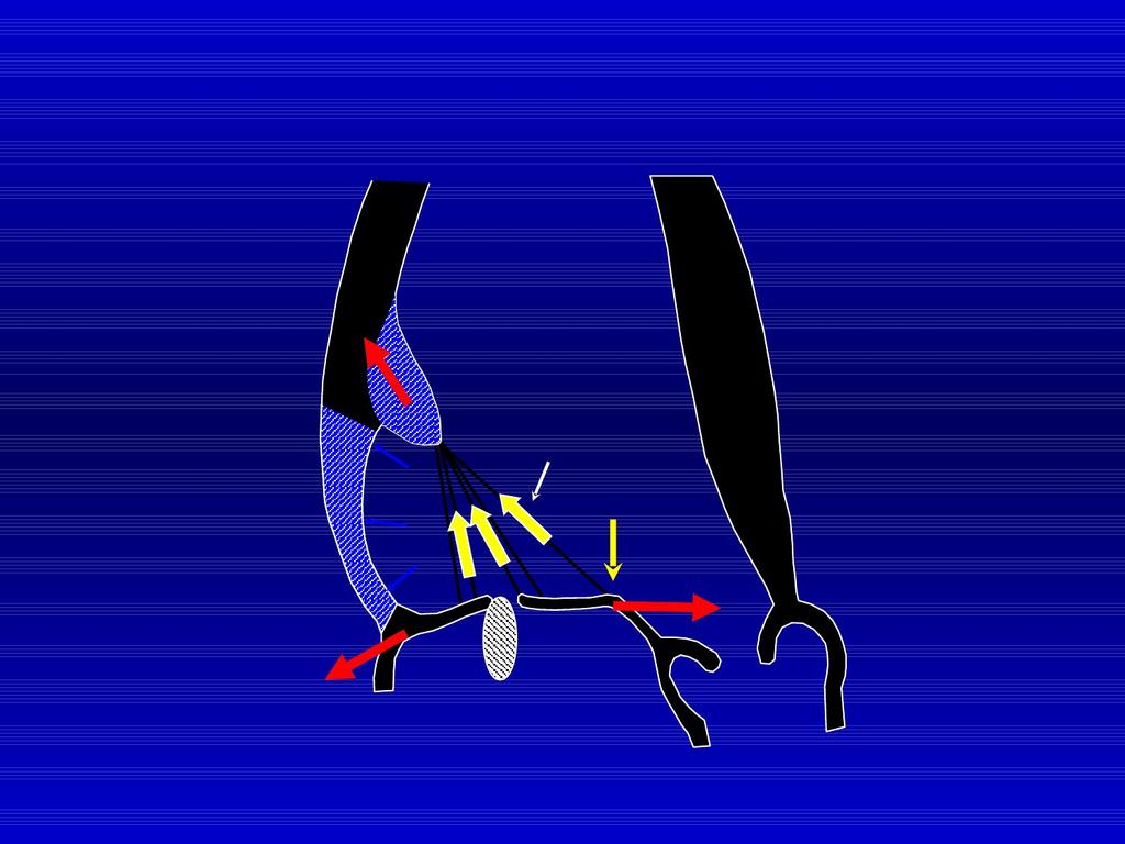 Mechanisms of Ischemic Mitral Regurgitation Papillary muscle traction