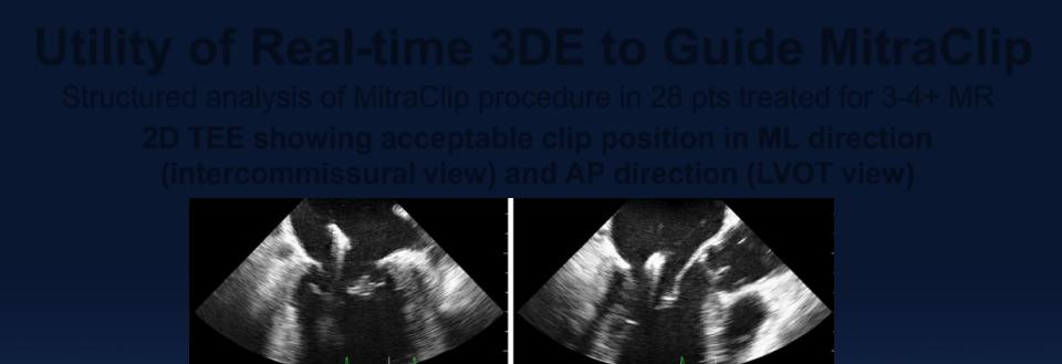 Utility of Real-time 3DE to Guide MitraClip Structured analysis