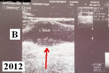 ιστορικό ΣΝ AY 140/86 mmhg FRS 10-ετη 12.