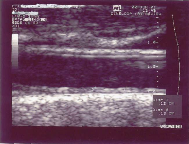 IMT of the arterial wall: a direct measurement