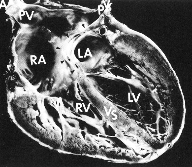 Postoperative specimen of TGA after the Mustard operation Warnes, C. A.