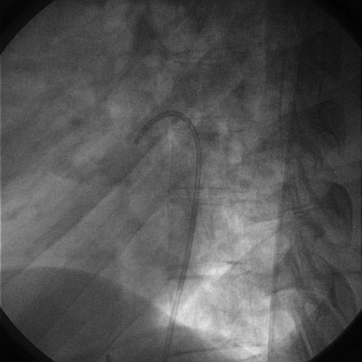 stenotic MAPCA -
