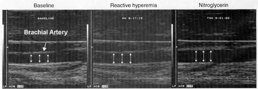 Assessment of endothelial function Non-invasive Ultrasound imaging of the brachial