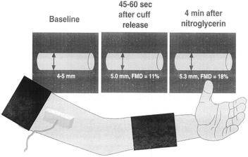 (endotheliumdependent dilation); FLOW-MEDIATED DILATION (FMD) after 400 mcg GTN