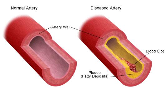 The effects of estrogen on atherosclerotic process depend on the state of vascular pathology