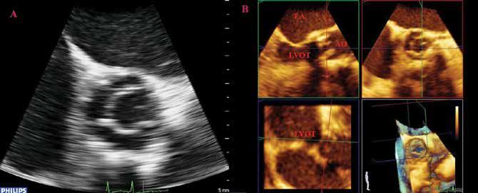 Εικόνα 8: Απεικόνιση με την τριδιάστατη ηχωκαρδιογραφία προσθετικής αορτικής βαλβίδας με την ανάδειξη των 2 κεκλιμένων δίσκων (μπλε βέλη) σε ανοικτή θέση.