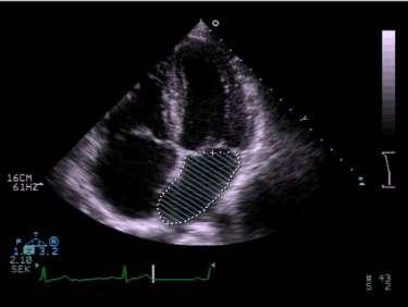 twice the effect of hypertension Obesity is identified as the most