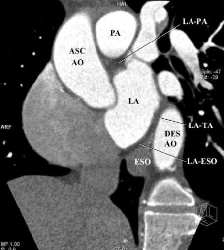 Epicardial adipose tissue Batal et al,