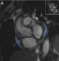 Pericardial fat & ablation outcome Pericardial fat is