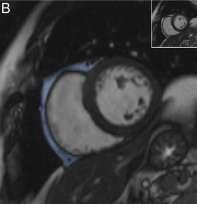AF, left atrial volumes, and poorer outcomes after AF