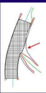 Διαδικασία της στρατηγικής 1 stent Βελτιστοποιήση του εγγύς τμήματος του κύριου κλάδου.