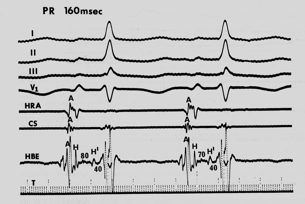Εντός του His αποκλεισµός µε φυσιολογικό διάστηµα PR
