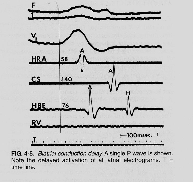 Biatrial