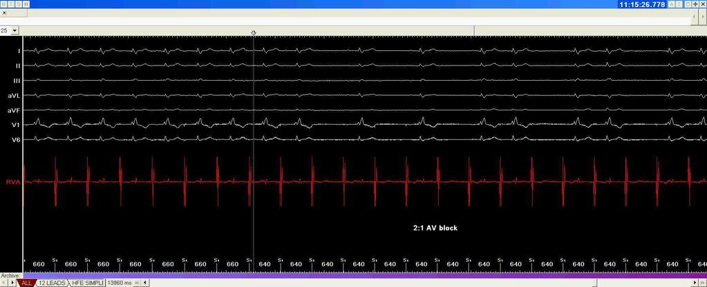 2:1 AV block induced by