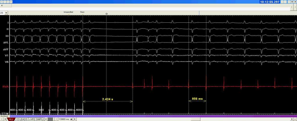 CSNRT (after atrial