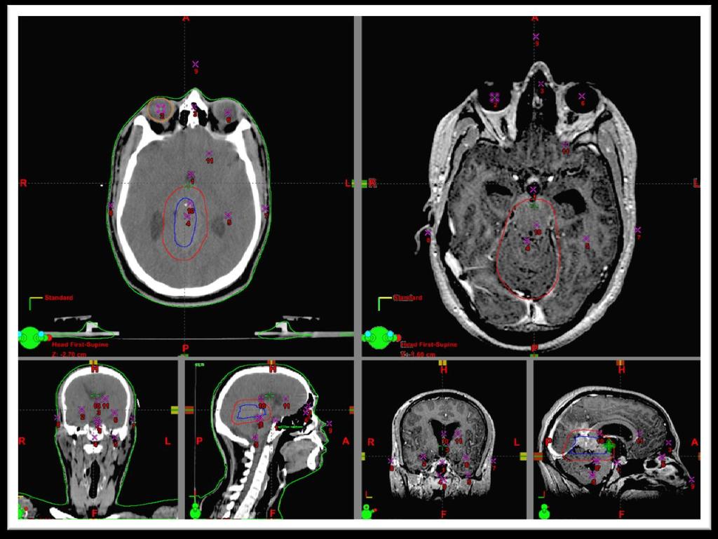 Εικόνα 10 - παράδειγμα χρήσης Διακριτών σημείων σε καταχώρηση CT-MRI σε κρανίο. Προέρχεται από την εφαρμογή Eclipse της Varian.