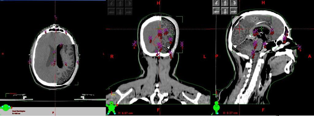 Στις συνδυασμένες απεικονίσεις μεταξύ CT και PET ή SPECT, συνήθως η απεικόνιση του PET εμφανίζεται επάνω σε αυτήν της CT με απόχρωση χρώματος διαφορετικού του γκρι.