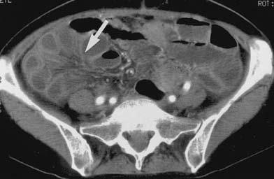 Coma shaped loop Beak sign