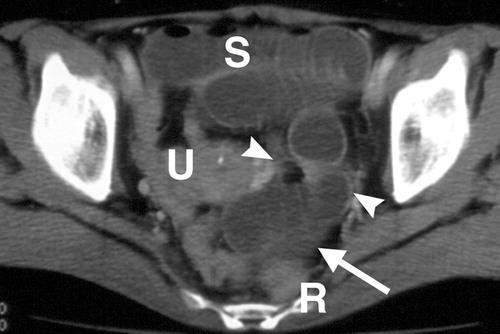 Broad ligament hernia N. Takeyama, T. Gokan, Y. Ohigiya et al.