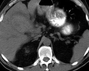 κύστης (υπέρπυκνο περιεχόμενο) CT Findings of