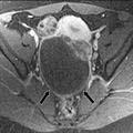 σύστοιχα Αιμορραγία MRI of acute abdomen and pelvis: