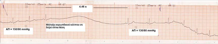 148 Ως καρδιοανασταλτική αντίδραση ορίστηκε η μέγιστη επιβράδυνση της καρδιακής συχνότητας, εκφραζόμενη ως το μέγιστο RR διάστημα κατά τα πρώτα 10 s μετά την έναρξη της μάλαξης.