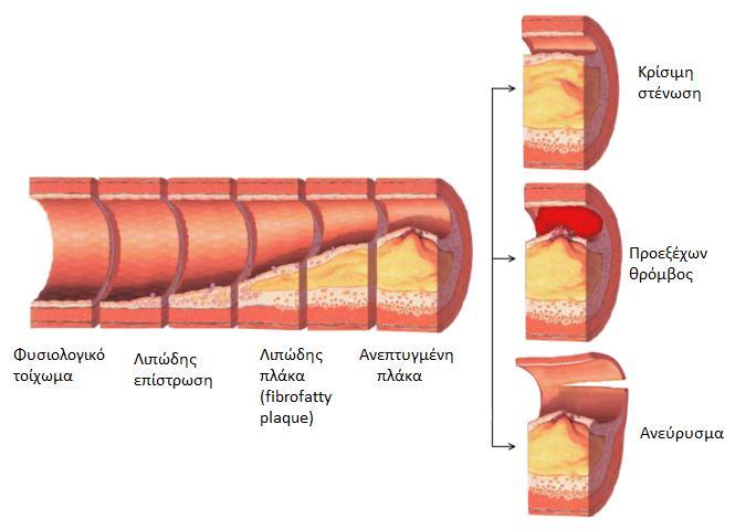 4 Εικόνα 3: Πιθανά σενάρια εξέλιξης της αθηρωματικής πλάκας [7]. Δύο είναι οι κατηγορίες παραγόντων της νόσου [8]: 1.