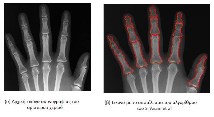 59 Εικόνα 24: Παράδειγμα εφαρμογής του αλγορίθμου που παρουσιάζεται στο [138]. Στην εικόνα (α) φαίνεται η αρχική εικόνα ακτινογραφίας του αριστερού χεριού.