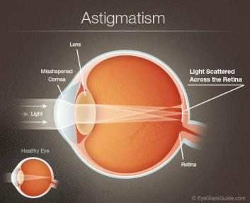 Εικόνα 1.7: Εστίαση ακτινών φωτός σε αστιγματικό οφθαλμό. (http://abileneadvancedeyecare.com/eye-insights/astigmatism.
