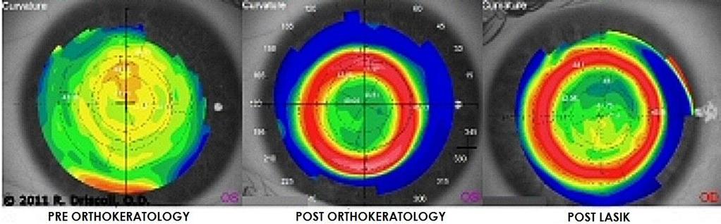 της (Ruston et. al., 2004; Contact Lens Update, 2015).