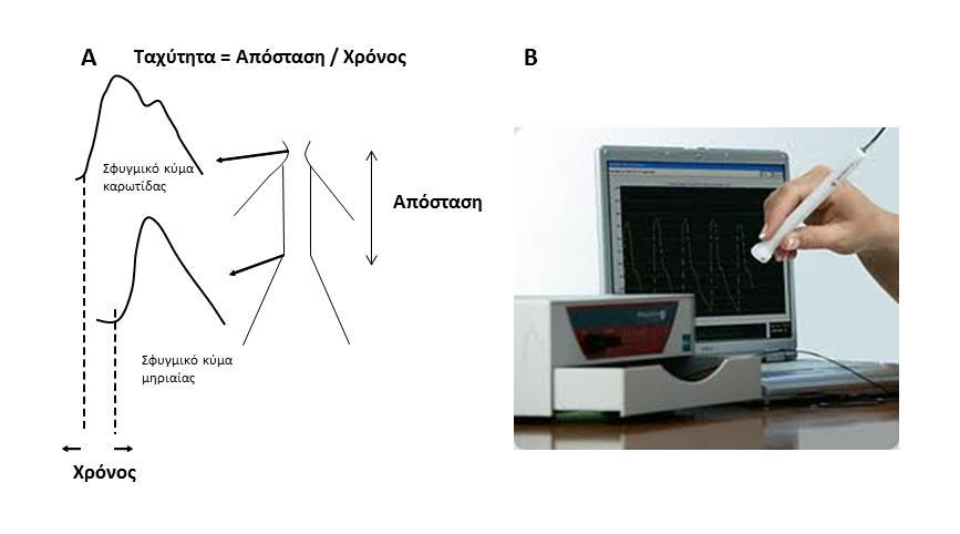 φέρει στο άκρο της πιεζοηλεκτρικούς αισθητήρες και η καταγραφή με ειδικό λογισμικό (SphygmoCor).