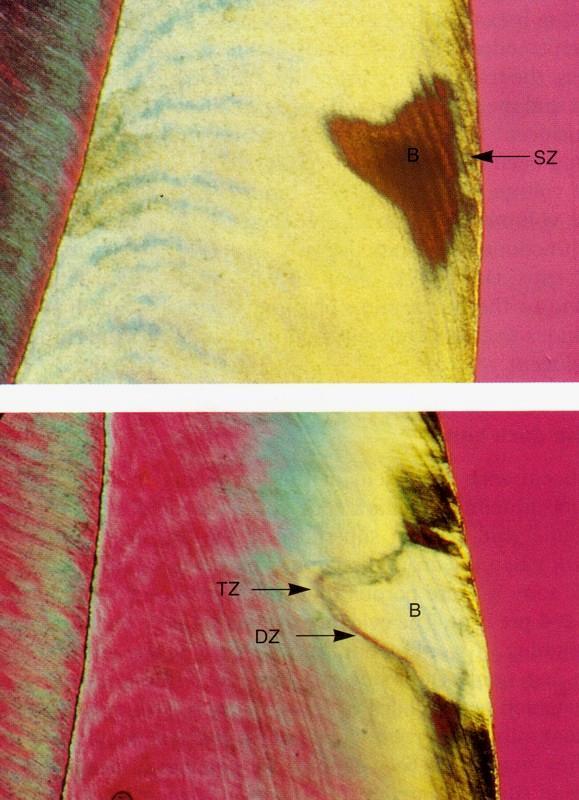 Ιστοποθολογικές μεταβολές κατά τη διάρκεια της τερηδόνας Κατά τη διάρκεια σχηματισμού μιας τερηδονικής αλλοίωσης στην αδαμαντίνη μπορούν να παρατηρηθούν τέσσερις διακριτές ζώνες (Εικόνα) α) το