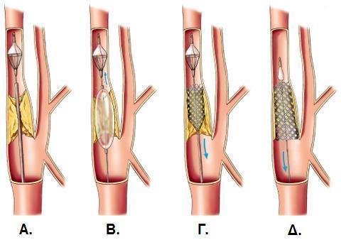 Εικόνα 19. Ενδαγγειακή αποκατάσταση καρωτιδικής νόσου. Α. Έκπτυξη της συσκευής προστασίας από έμβολα (φίλτρο) περιφερικά της βλάβης Β.