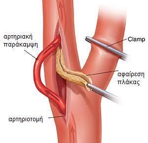 33 διατηρώντας την αιματική ροή κατά τη διάρκεια της χειρουργικής επέμβασης (Εικόνα 3). Εικόνα 3. Αρτηριακή παράκαμψη (shunt) κατά τη διάρκεια της καρωτιδικής ενδαρτηρεκτομής (www.fairviewebenezer.