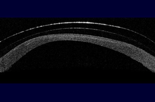 Φωτογραφία 3 : Aπεικόνιση της εικόνας ενός κερατοειδούς ο οποίος ανέπτυξε εκτασία έπειτα από επέμβαση ακτινωτής Κερατοτομής και στη συνέχεια LASIK.